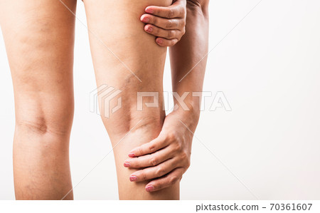 Woman painful varicose and spider veins on leg 70361607
