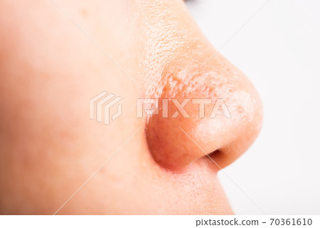 Woman large pores have freckles cheek oily, acne pimple on nose 70361610