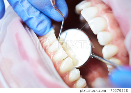 Macro close up of Human teeth with hatchet and mouth mirror. Shallow dof. Macro close up of Human teeth with hatchet and mouth mirror. Shallow dof. 70379328