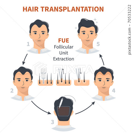 Stages of hair transplantation FUE Unit Extraction Stages of hair transplantation FUE Unit Extraction 70533222