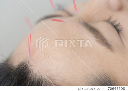 Acupuncture treatment Acupuncture treatment 70648608