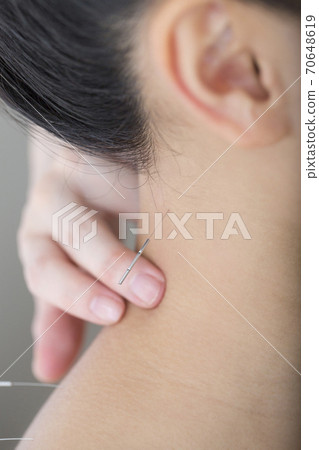 Acupuncture treatment Acupuncture treatment 70648619