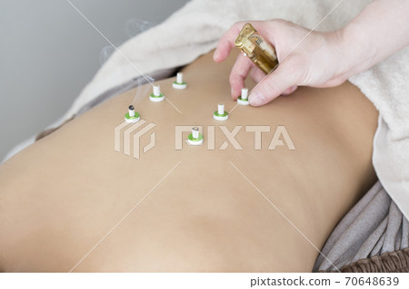 Image of acupuncture and moxibustion 70648639