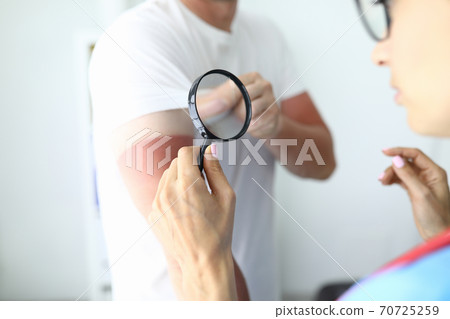 Nurse holds her hand and looks at sunburn on her hand Nurse holds her hand and looks at sunburn on her hand 70725259