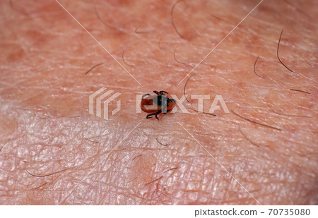 Small tick Ixodes ricinus crawling on human skin 70735080