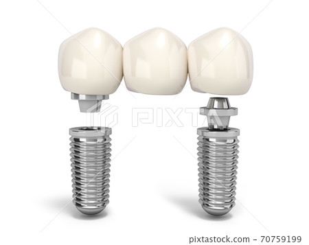 Tooth human multitooth implant Dental concept Human teeth or dentures  multitooth 3d render on white 70759199