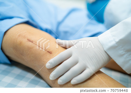 Asian senior or elderly old lady woman patient show her scars surgical total knee joint replacement Suture wound surgery arthroplasty on bed in nursing hospital ward Asian senior or elderly old lady woman patient show her scars surgical total knee joint replacement Suture wound surgery arthroplasty on bed in nursing hospital ward 70759448