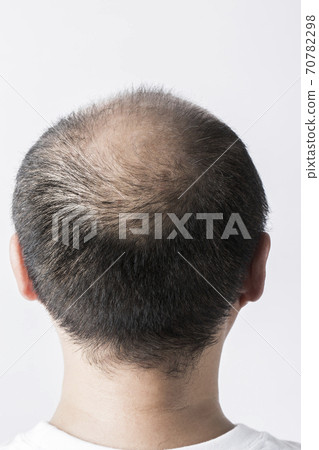 A thin hair man 70782298