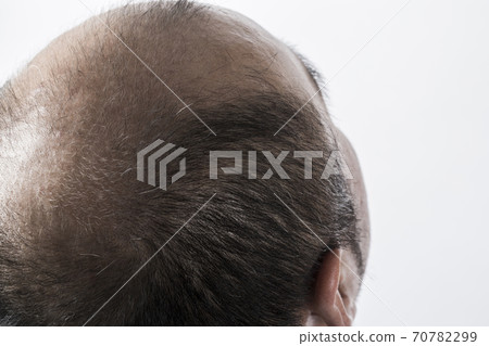 A thin hair man 70782299