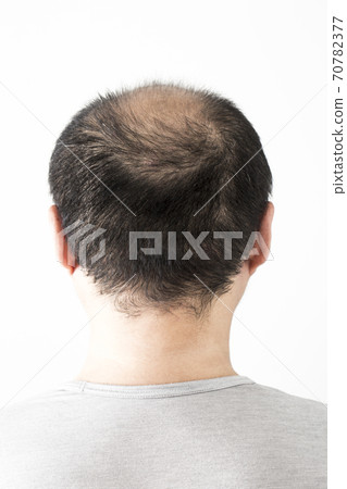A thin hair man A thin hair man 70782377