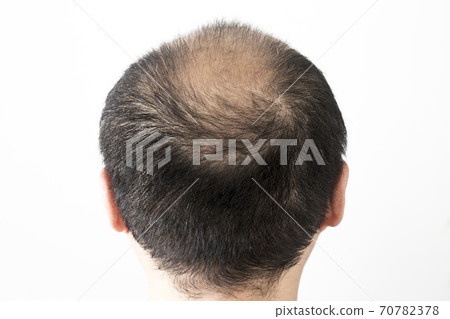 A thin hair man 70782378