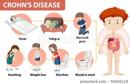 Medical infographic of Crohn's Disease 70808229