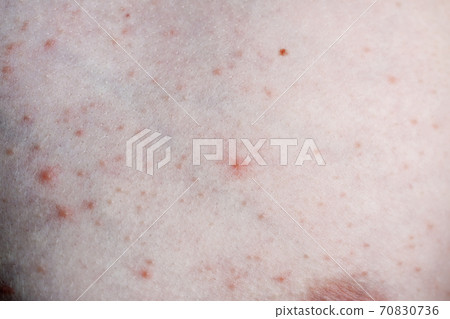 Close up image of a little boy's body suffering severe urticaria, nettle rash also called hives 70830736