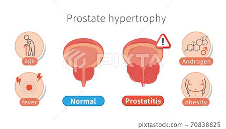 男性健康和不健康的前列腺,前列腺肥大的原因和白色背景中的炎症 70838825