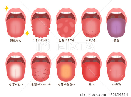 舌頭疾病 70854714