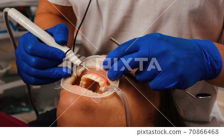 The dentist removes tartar using ultrasound, the patient at the dentist. Retractor for isolation of lips and gums. The dentist removes tartar using ultrasound, the patient at the dentist. Retractor for isolation of lips and gums. 70866468