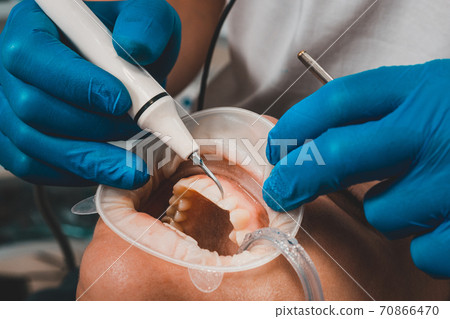 The dentist removes tartar using ultrasound, the patient at the dentist. Retractor for isolation of lips and gums. The dentist removes tartar using ultrasound, the patient at the dentist. Retractor for isolation of lips and gums. 70866470