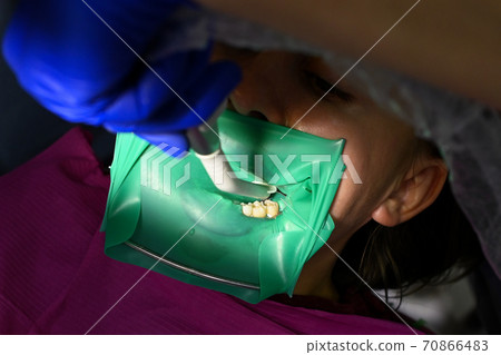 A woman at a dentist's appointment, a dentist uses a rubber dam and dental tools for treatment. A woman at a dentist's appointment, a dentist uses a rubber dam and dental tools for treatment. 70866483