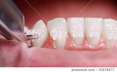Dental specialist attaching white braces to patient teeth. Dental specialist attaching white braces to patient teeth. 70878877