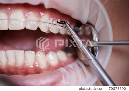 Close-up picture of mouth during dental procedure of removing rubber bands from brackets Close-up picture of mouth during dental procedure of removing rubber bands from brackets 70878890