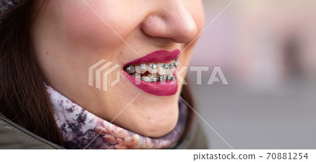 The brace system in the girl's smiling mouth, close-up of red lips The brace system in the girl's smiling mouth, close-up of red lips 70881254