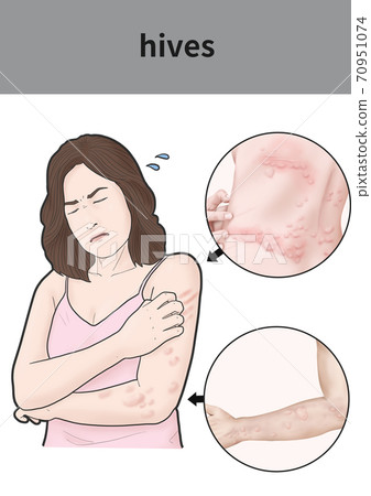 Urticaria women 70951074