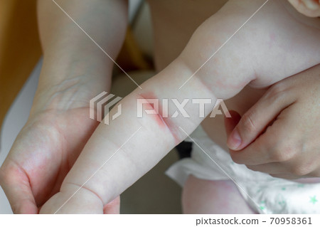 Prickly heat. Close-up of the folds of the hand of a newborn baby with red skin. 70958361