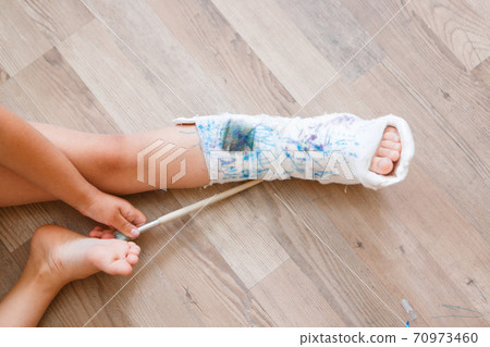 broken leg. damage to the bones. a child paints a plaster. a girl with a marker 70973460