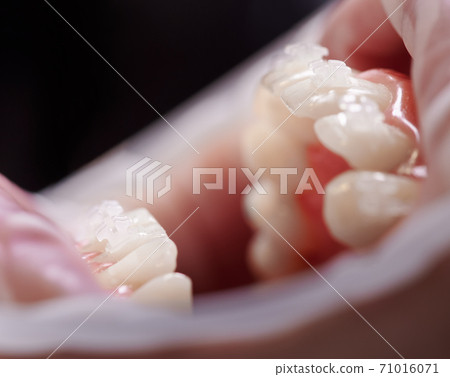 White orthodontic brackets on patient teeth. White orthodontic brackets on patient teeth. 71016071