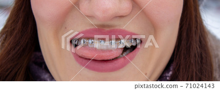 Braces on the girl's teeth smiling, macro photo teeth, close-up lips, Braces on the girl's teeth smiling, macro photo teeth, close-up lips, 71024143