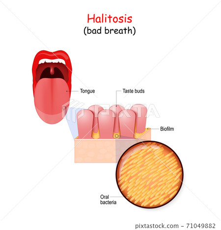 Bad breath and bacteria that cause halitosis. Human mouth Bad breath and bacteria that cause halitosis. Human mouth 71049882