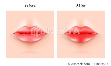Lips Dry After Moistening. Protect Lips before and after. Lips Dry After Moistening. Protect Lips before and after. 71049883