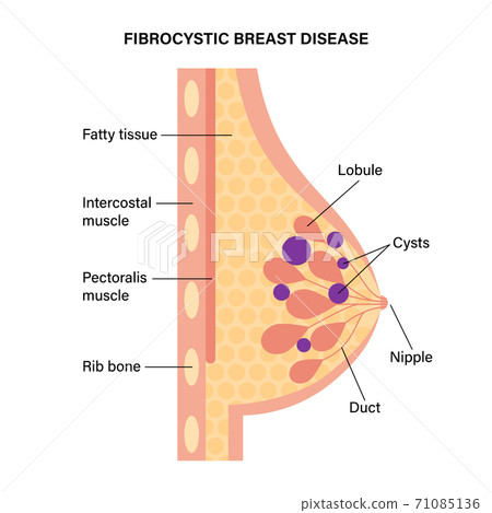 Breast disease concept 71085136