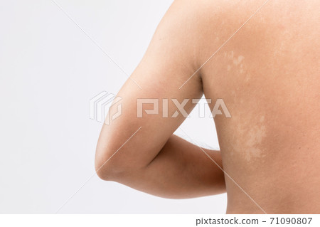 Macro white Pityriasis or Tinea Versicolor on back skin. Used for skincare concept 71090807