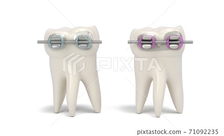 dental braces with plastic and metal base are installed on the tooth 3d render on wite 71092235