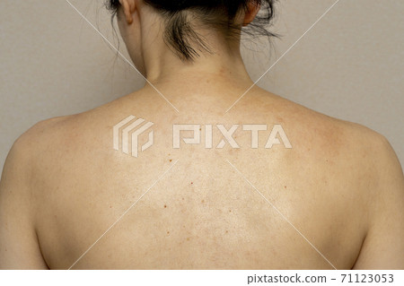 患有過敏和濕疹的女性的肩blade骨 患有過敏和濕疹的女性的肩blade骨 71123053