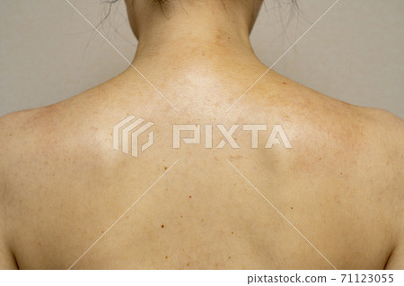 Around the shoulder blades of women with allergies and eczema 71123055