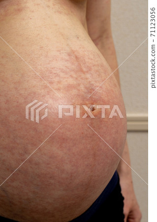 Belly of pregnant women with allergies and eczema Belly of pregnant women with allergies and eczema 71123056