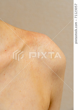 Shoulders of women with allergies / eczema 71123057
