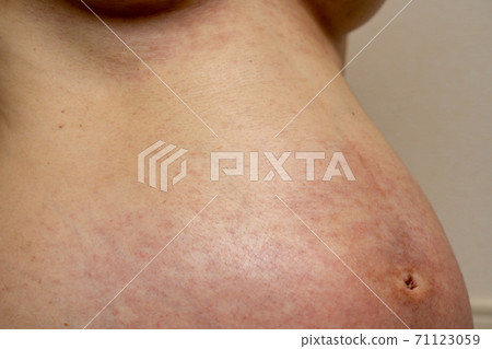 一名孕婦過敏和濕疹的腹部 71123059