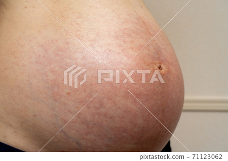 Belly of pregnant women with allergies and eczema 71123062