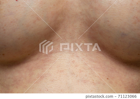 Bust of women with allergies / eczema Bust of women with allergies / eczema 71123066