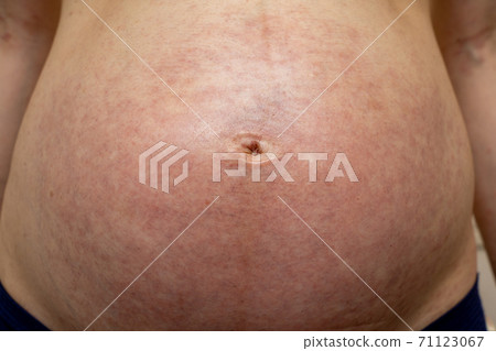 Belly of pregnant women with allergies and eczema 71123067