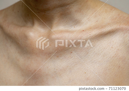 Clavicle of a woman with allergies / eczema 71123070