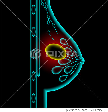 Breast disease concept 71129593