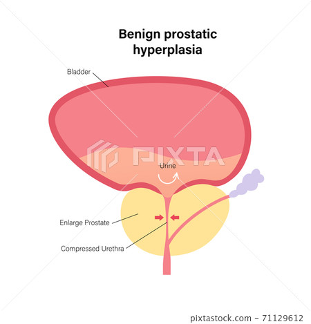 BPH info concept - Stock Illustration [71129612] - PIXTA