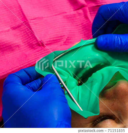 Installation of a cofferdam to the patient, modern dental equipment, treatment in sterile conditions. Installation of a cofferdam to the patient, modern dental equipment, treatment in sterile conditions. 71151835
