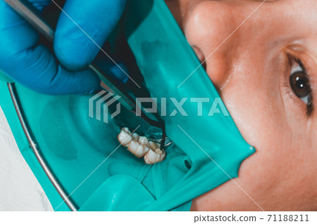 treatment of a chewing tooth, the dentist put a rubber dam, uses sterile tools, uses modern technology. treatment of a chewing tooth, the dentist put a rubber dam, uses sterile tools, uses modern technology. 71188211