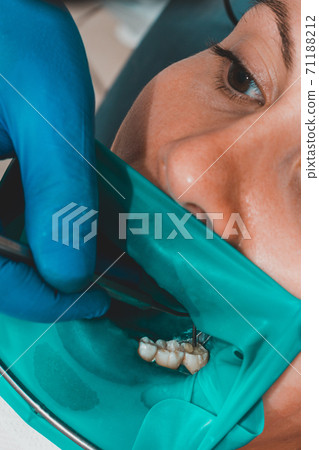 treatment of a chewing tooth, the dentist put a rubber dam, uses sterile tools, uses modern technology. 71188212