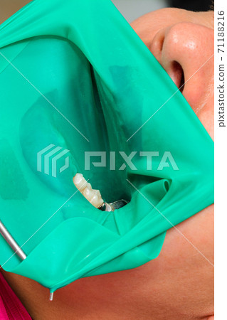 Restoration of a chewing surface by means of material for filling with photopolymer by means of the Rubber Dam system. Restoration of a chewing surface by means of material for filling with photopolymer by means of the Rubber Dam system. 71188216